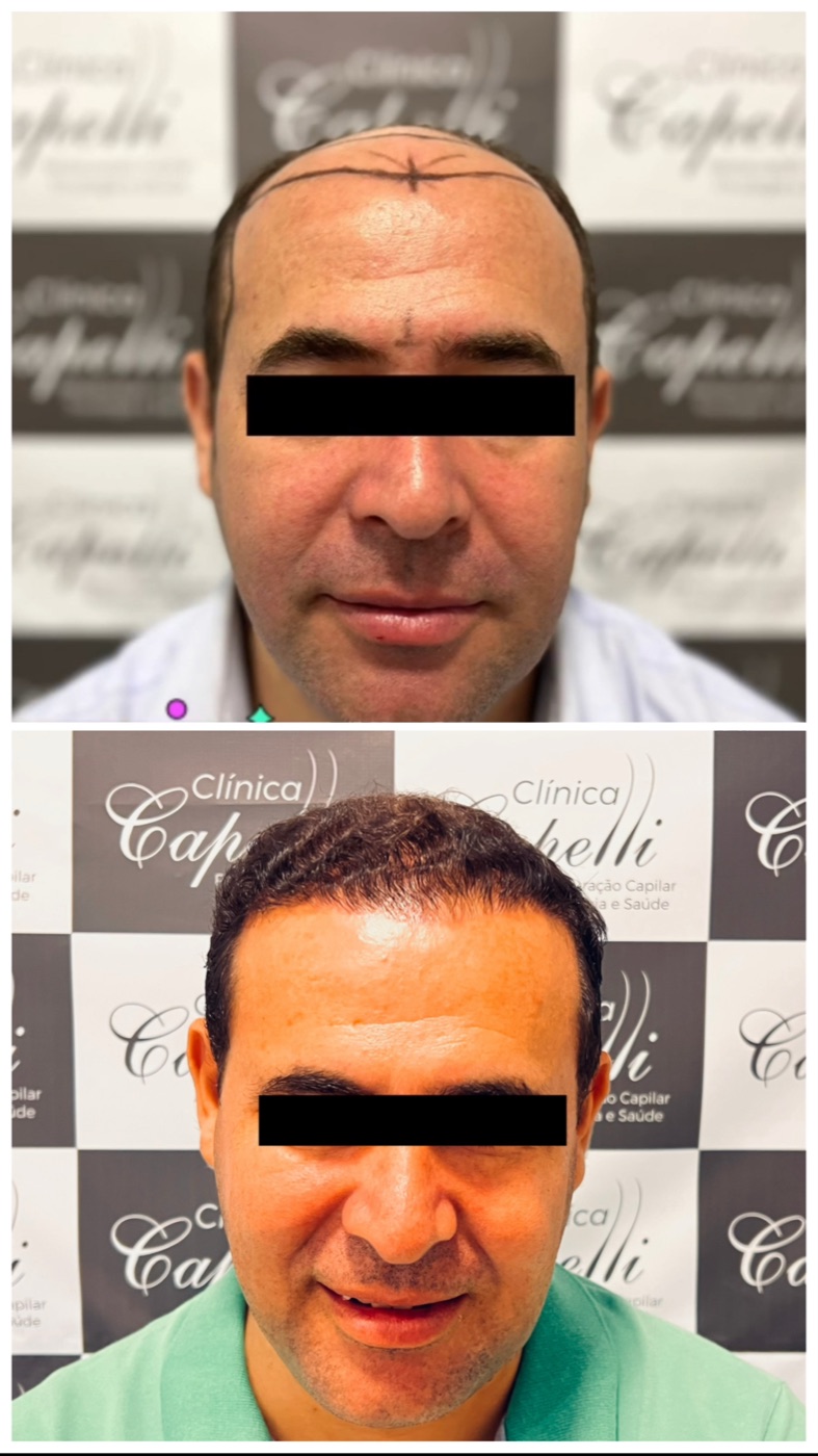 Antes e depois de transplante capilar na Clínica Capelli